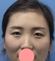 我也赶个潮流，做个超声波双眼皮手术！分享效果啦~~297