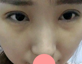 我也赶个潮流，做个超声波双眼皮手术！分享效果啦~~297