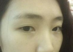 超雅医学美容院超 声 波双眼 皮帮你塑造完美眼形！