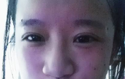 超 声 波双眼 皮得效果你体验过吗? 超 声 波双眼 皮得效果你体验过吗?