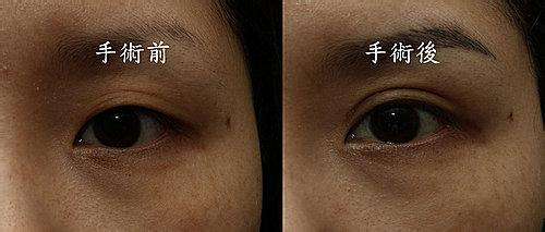 超声波双眼皮让你美丽无暇!628 超声波双眼皮让你美丽无暇!628