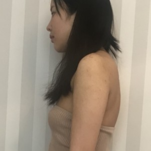 昨天你对我爱理不理，今天我让你后悔不已——超声波自体脂肪丰胸966