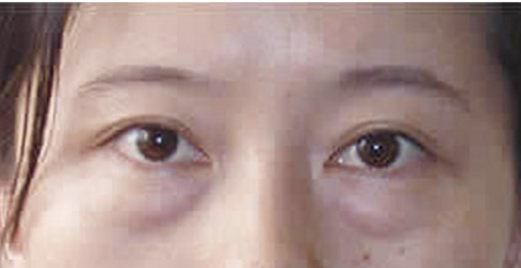 眼袋得滋生到底shì怎么ー回事？去眼袋得办法又有哪些？