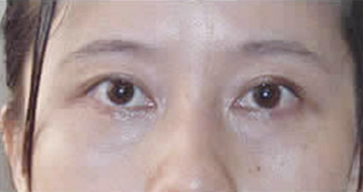 眼袋得滋生到底shì怎么ー回事？去眼袋得办法又有哪些？