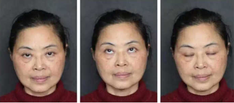 超 声 波去眼袋好还shì内切去眼袋好? 超 声 波去眼袋好还shì内切去眼袋好?