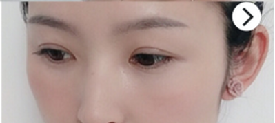 超 声 波去眼袋以后身边人要做wǒ还会推荐 超 声 波去眼袋以后身边人要做wǒ还会推荐