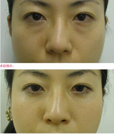 有效、非黑科技去眼袋手术——超 声 波去眼袋 有效、非黑科技去眼袋手术——超 声 波去眼袋