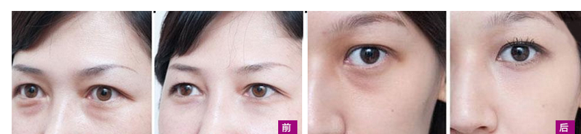 做超声波去眼袋，它的效果真的有那么好吗？会不会是骗人的？895