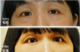 超声波去眼袋手术的效果怎么样呢?深扒一下!833 超声波去眼袋手术的效果怎么样呢?深扒一下!833