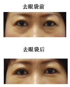 超声波去眼袋案例分析,看看它的效果如何吧!304 超声波去眼袋案例分析,看看它的效果如何吧!304