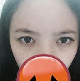 超声波去眼袋真实案例,附上照片的哦599 超声波去眼袋真实案例,附上照片的哦599