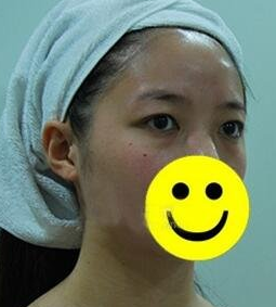超声波去眼袋真实案例,附上照片的哦599 超声波去眼袋真实案例,附上照片的哦599