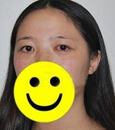 超声波去眼袋真实案例,附上照片的哦599 超声波去眼袋真实案例,附上照片的哦599