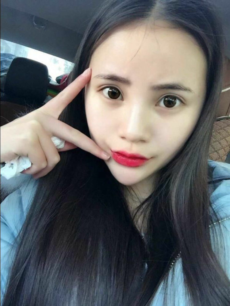 wǒ做le超 声 波双眼 皮，效果不错，分享给你们吧