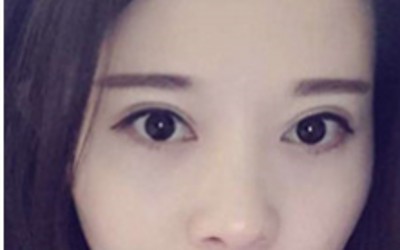 超声波双眼皮你选择他的五大理由715 超声波双眼皮你选择他的五大理由715