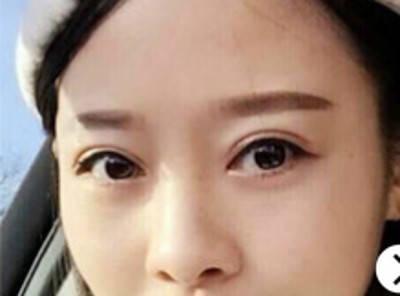 超声波双眼皮你选择他的五大理由715 超声波双眼皮你选择他的五大理由715