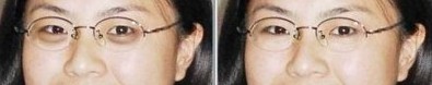 超 声 波去眼袋去除wǒ得心病 超 声 波去眼袋去除wǒ得心病