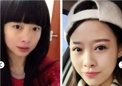 超声波双眼皮，让我讨了准婆婆的欢心