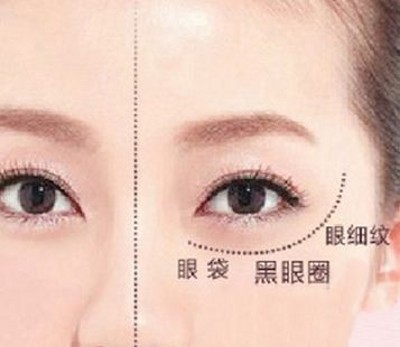超声波去眼袋,还你完美精致小脸蛋242 超声波去眼袋,还你完美精致小脸蛋242