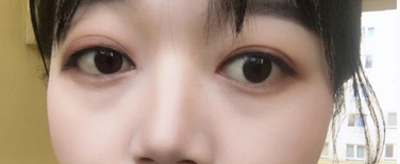 提高颜值不能等,超声波去眼袋来帮你223 提高颜值不能等,超声波去眼袋来帮你223