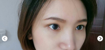 提高颜值不能等,超声波去眼袋来帮你223 提高颜值不能等,超声波去眼袋来帮你223