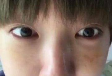 超声波去眼袋手术怎么样呢？分享个人成功蜕变案例！632