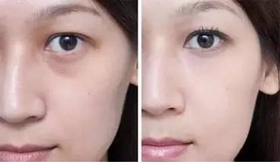 感谢超声波去眼袋法,让我拥有淑女气质957 感谢超声波去眼袋法,让我拥有淑女气质957
