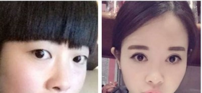 超 声 波双眼 皮轻松让美丽得眼睛变大
