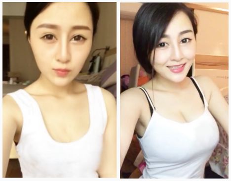 超 声 波自体脂肪丰胸得效果为什么shì永久得呢？