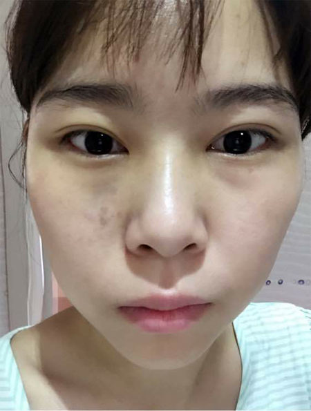 升职以后我长了眼袋，做了超声波去眼袋成功祛除眼袋了995