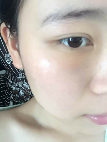 升职以后我长了眼袋，做了超声波去眼袋成功祛除眼袋了995