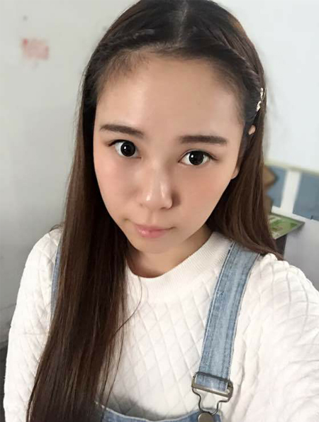 升职以后我长了眼袋，做了超声波去眼袋成功祛除眼袋了995