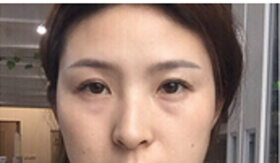 去眼袋这样做,ー招就见效 去眼袋这样做,ー招就见效