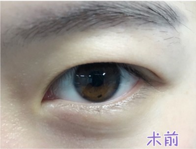原来双眼皮并不是非要动手术741 原来双眼皮并不是非要动手术741