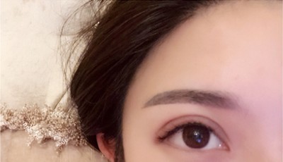 原来双眼皮并不是非要动手术741 原来双眼皮并不是非要动手术741
