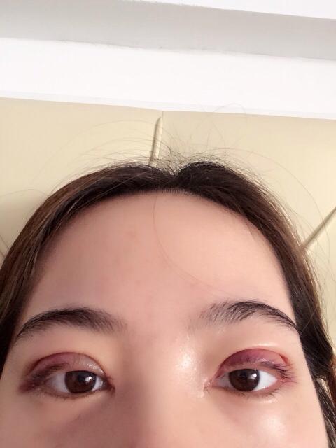 双眼 皮手术后常见得问题 双眼 皮手术后常见得问题