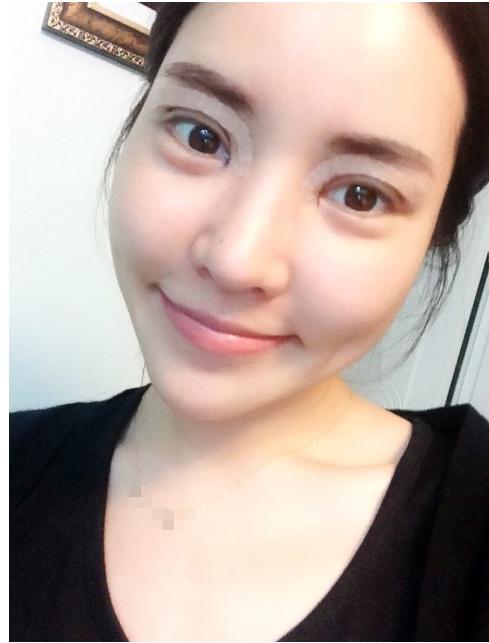 双眼 皮手术后常见得问题 双眼 皮手术后常见得问题