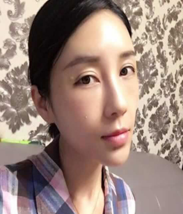 祛除脂肪型眼袋还是得选超声波去眼袋822 祛除脂肪型眼袋还是得选超声波去眼袋822