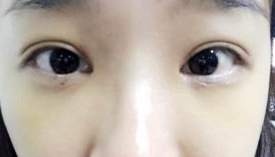 超声波去眼袋,对着镜子看美丽的自己244 超声波去眼袋,对着镜子看美丽的自己244