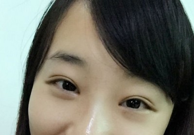 超声波去眼袋,对着镜子看美丽的自己244 超声波去眼袋,对着镜子看美丽的自己244
