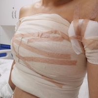 超声波自体脂肪丰胸后倍儿有面017 超声波自体脂肪丰胸后倍儿有面017
