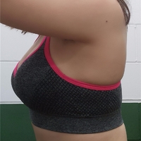 超声波自体脂肪丰胸后倍儿有面017 超声波自体脂肪丰胸后倍儿有面017