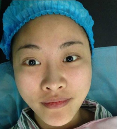 超声波去眼袋,让你重返青春美少女940 超声波去眼袋,让你重返青春美少女940