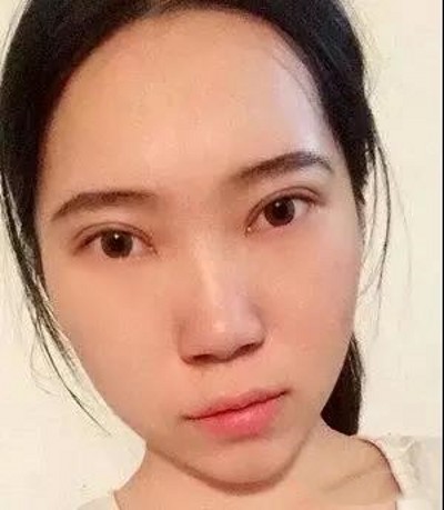 超声波去眼袋,让你重返青春美少女940 超声波去眼袋,让你重返青春美少女940