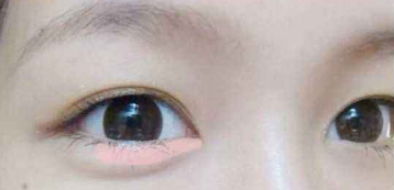 有眼袋怎么解决呢?超声波去眼袋!!242 有眼袋怎么解决呢?超声波去眼袋!!242