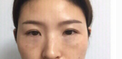 超 声 波去眼袋,男女都喜欢 超 声 波去眼袋,男女都喜欢