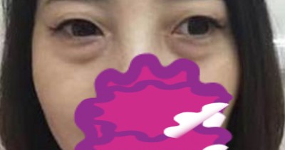 超声波去眼袋,看谁敢说我像老大妈419 超声波去眼袋,看谁敢说我像老大妈419