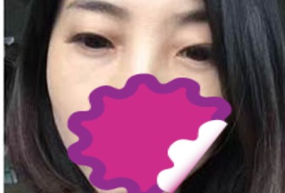 超声波去眼袋,看谁敢说我像老大妈419 超声波去眼袋,看谁敢说我像老大妈419