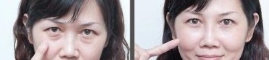 超声波去眼袋,认准超雅425 超声波去眼袋,认准超雅425