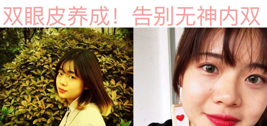超声波双眼皮手术保鲜期的长短和什么有关呢?633 超声波双眼皮手术保鲜期的长短和什么有关呢?633